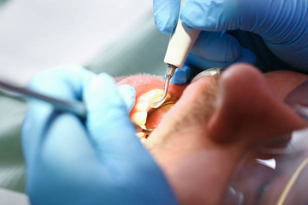 Urgent Tooth Repair in MD